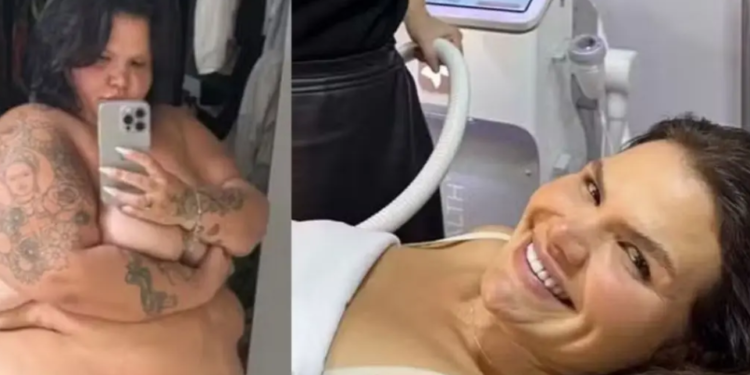 Thais Carla adota alta tecnologia estética contra flacidez após eliminar 100 kg na Bahia