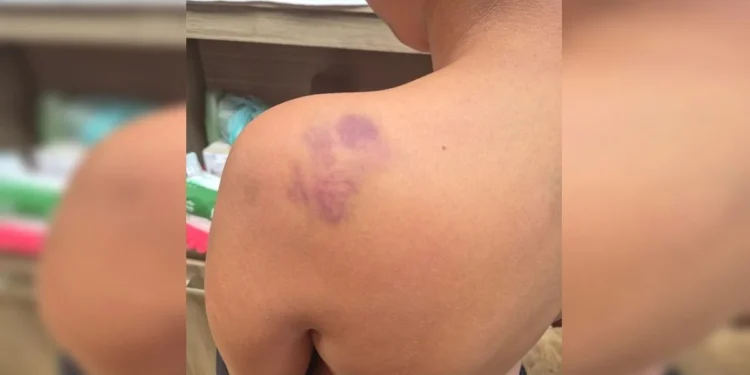 Aluno de 12 anos é vítima de ofensas racistas e acaba espancado dentro de escola pública no DF